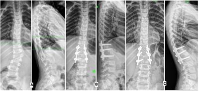 The results of surgical treatment of preschool and primary school age children with congenital deformation of the spine in isolated hemivertebra: Comparative analysis